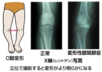 変形性膝関節って？