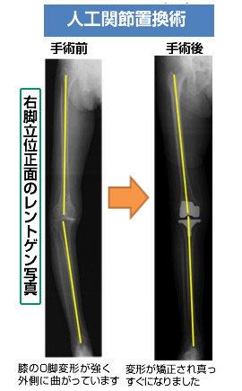 人口関節置換術